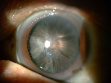 Figure 1: Image of a very advanced 'white' cataract
