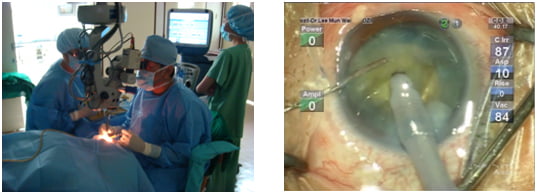 Figure 3: Modern cataract surgery done using a microscope (surgeon's view on the right)