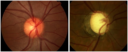 Normal optic nerve head(left) and damaged optic nerve head from glaucoma (right)