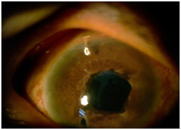 Optonol Shunt - a metal tube implant