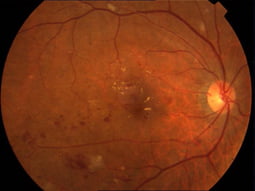 Dot and blot haemorrhages in the earlier stages of diabetic retinopathy