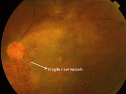 Formation of ‘new vessels’ (near optic disc) which are prone to bleeding