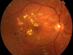 Leakage of fluid and proteins causing swelling at the macula
