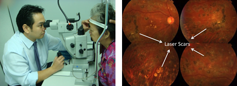 Laser treatment for PDR(right) and laser scars(left)