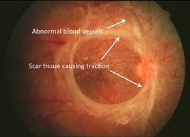 Advanced diabetic eye disease