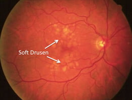 Figure 2: Dry AMD