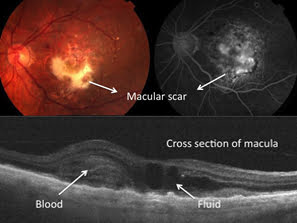 Figure 4: Colour photo of macula (top left), FFA image (top right) and OCT (bottom)