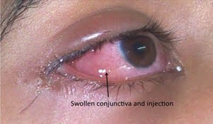 Eye redness and watering from conjunctivitis