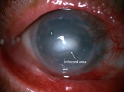 Infection of the cornea with diffuse eye redness and inflammation