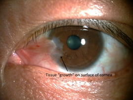 Pterygium in a patient’s left eye