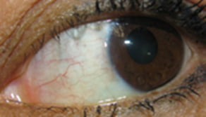 1 month post pterygium surgery – no stitches used