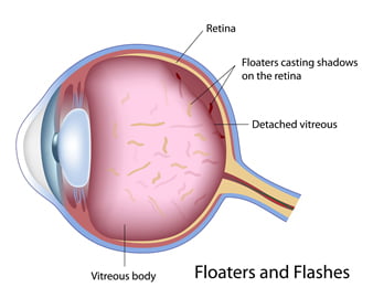 Posterior vitreous detachment