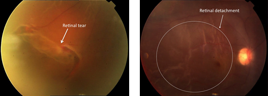 Large retinal tear(left) and retinal detachment(right)