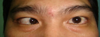 Figure 1: An in-turning squint also known as esotropia