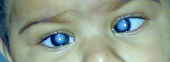 Figure 2: “White reflex” seen in child with congenital cataracts